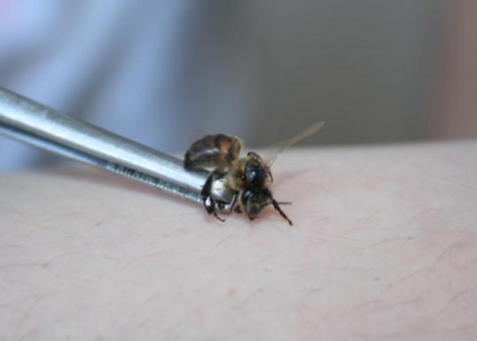 Пчелу сажают на руку человека. Лечение пчелиным ядом.